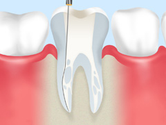 歯の根を残す根管治療