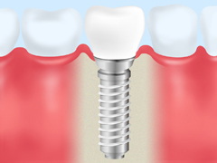 インプラント治療でより天然歯に近い機能回復を